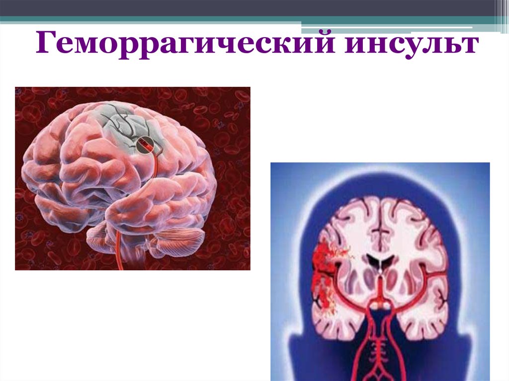 Инсульт левого полушария головного. Геморрагический инсульт и ишемический инсульт. ОНМК по геморрагическому типу. ОНМК геморрагический инсульт. Внутрижелудочковые кровоизлияния геморрагический инсульт.