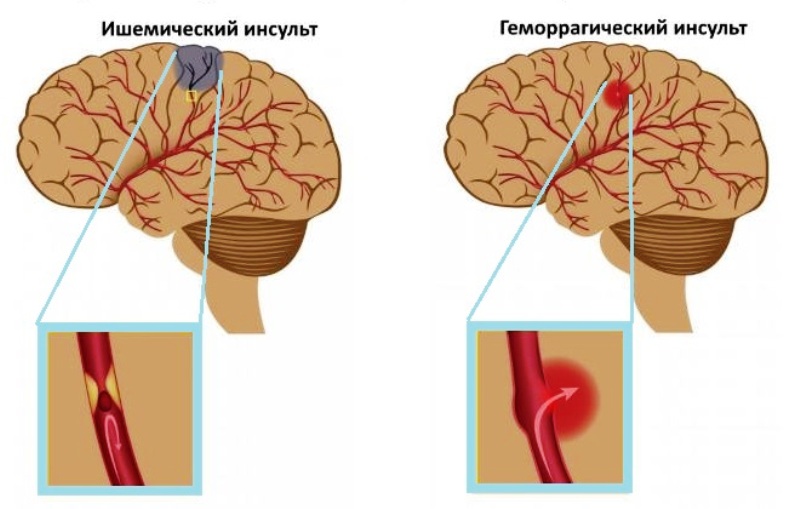 Посттравматический синдром