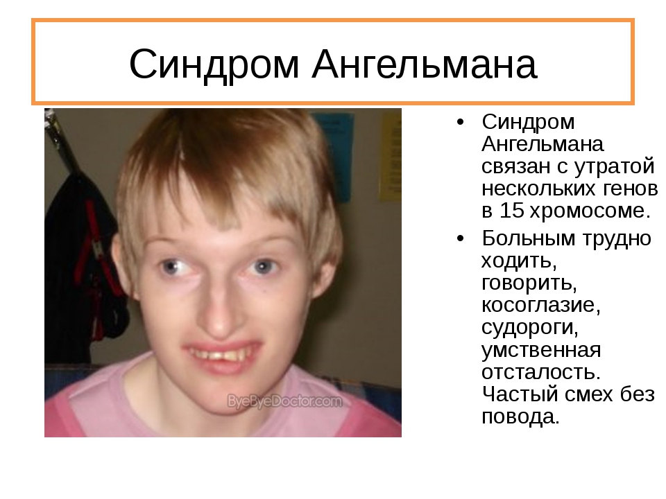Случай ранней пренатальной диагностики синдрома тричера коллинза (treacher collins syndrome, omim: 154500) 1-й тип, семейная форма