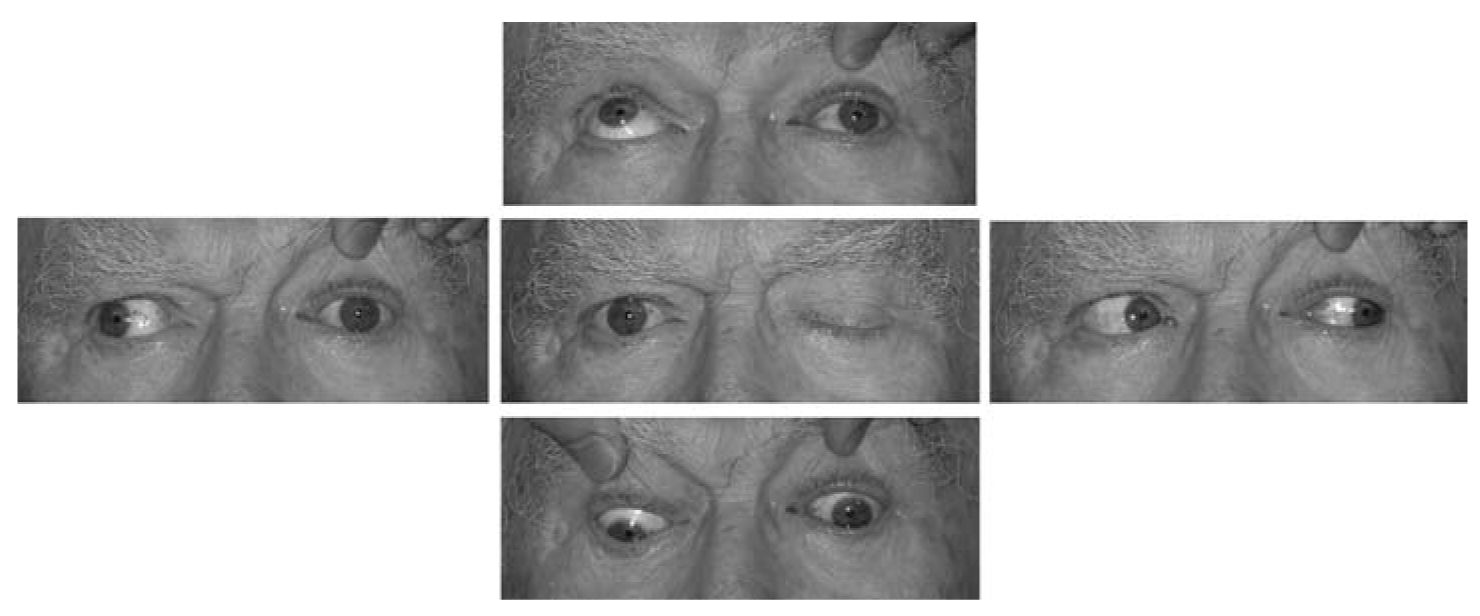 Жалобы на двоение в глазах. Бинокулярная диплопия. Бинокулярная диплопия причины. Нарушение зрения диплопия. Мононуклеарная диплопия.
