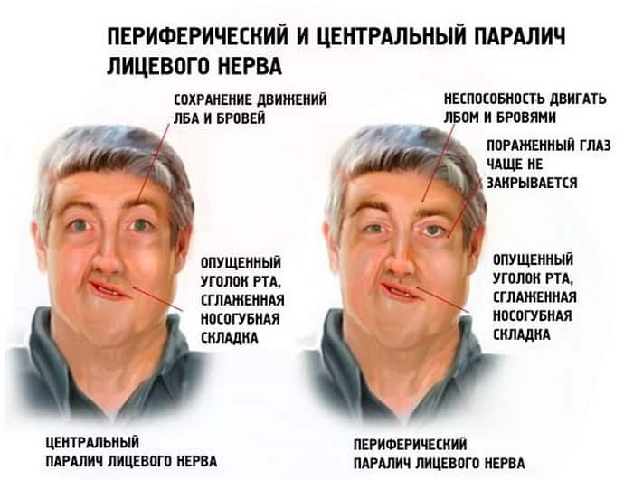 Морщины на лице [что это такое]: названия, типы, причины появления, методы устранения