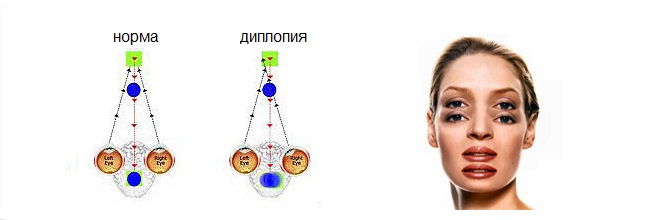 Раздвоение изображения в глазах причина