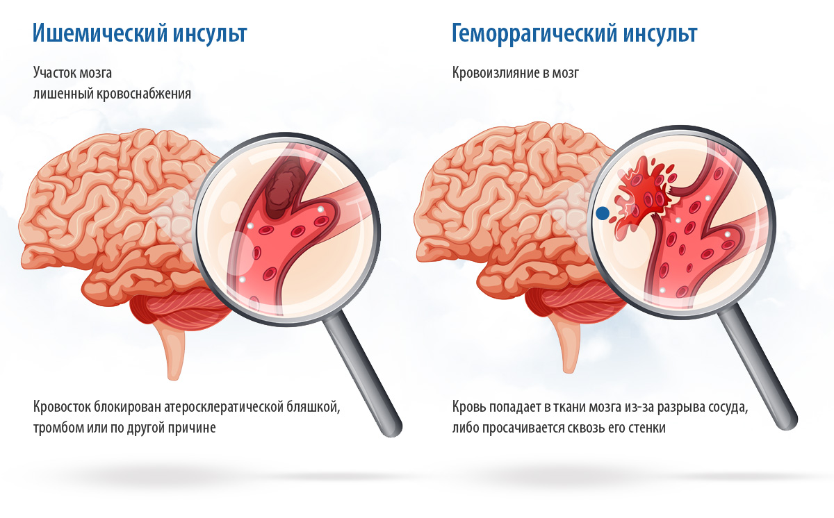 Ишемический инсульт и геморрагический инсульт картинки