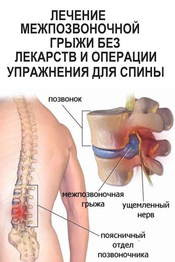 Лечение спины без операции