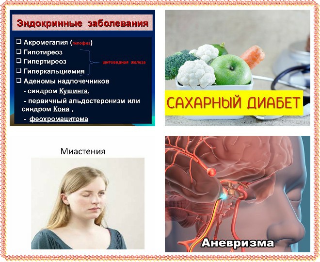 Причина двоения изображения в глазах